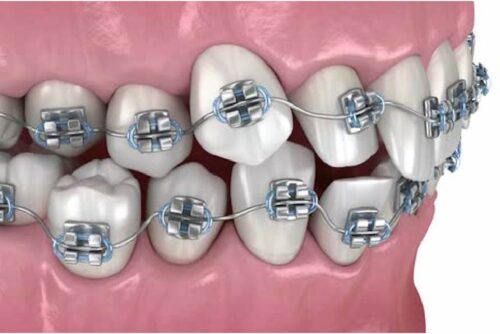 ব্রেসেস চিকিৎসা