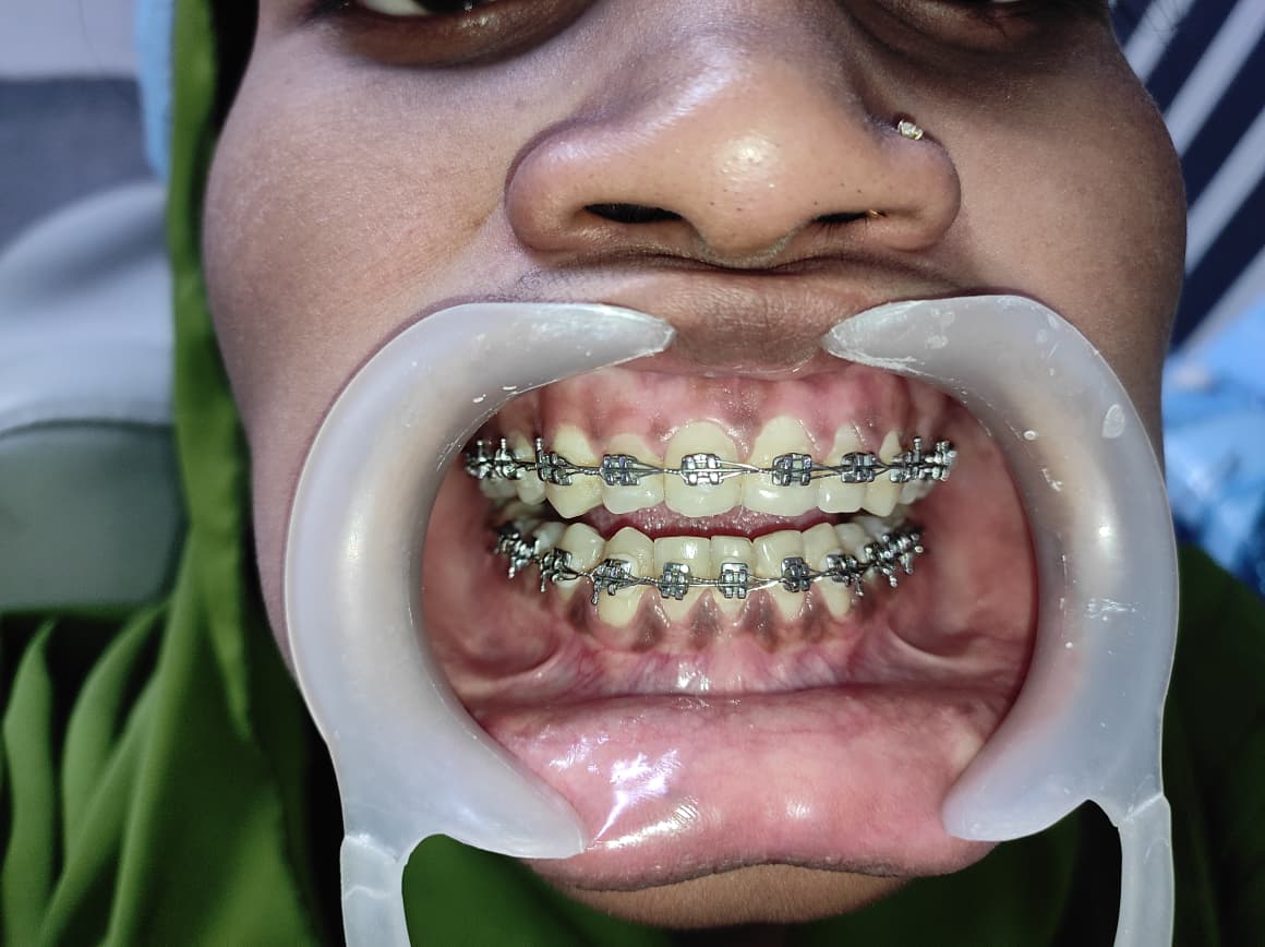 After teeth whitening