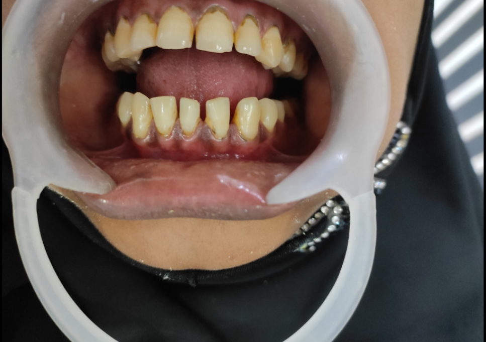 Before teeth whitening