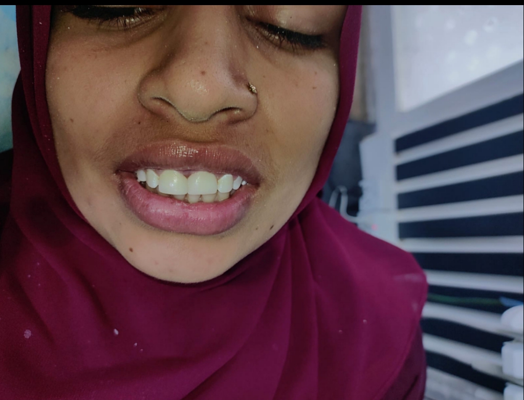 Before dental veneers