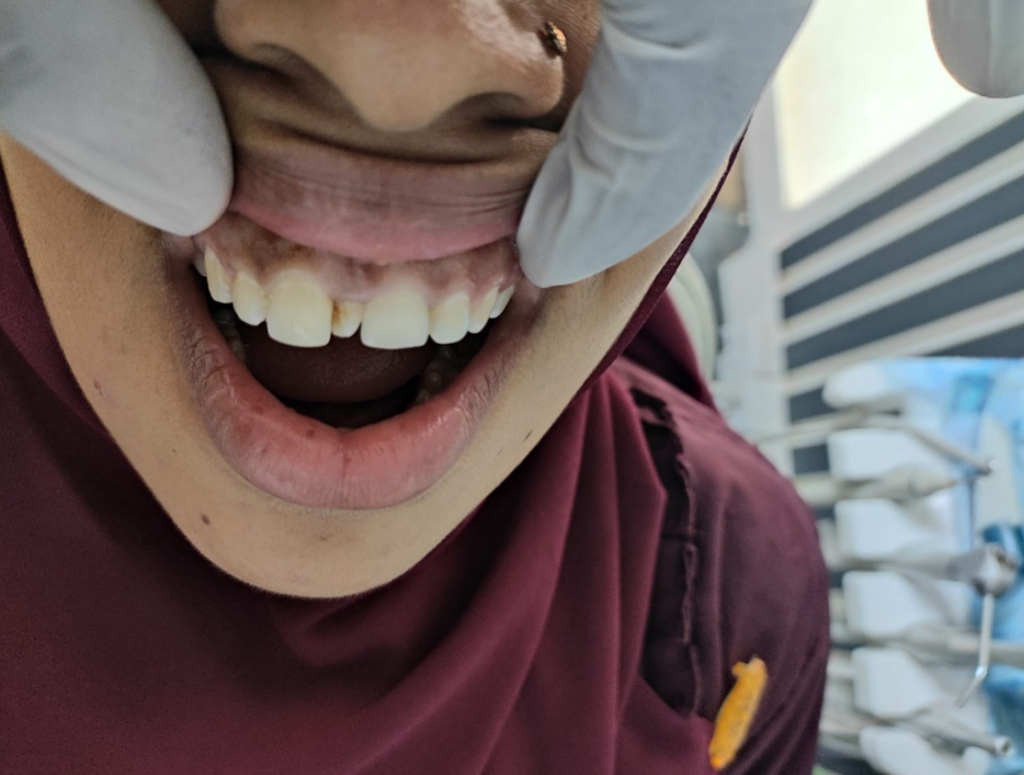 After dental veneers