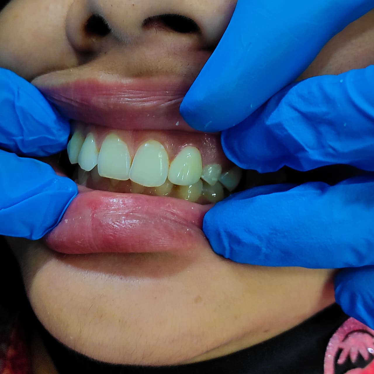 After orthodontic treatment