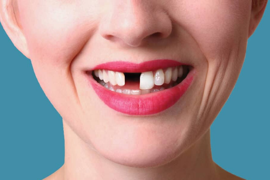 ফাইবার ব্রিজ চিকিৎসা